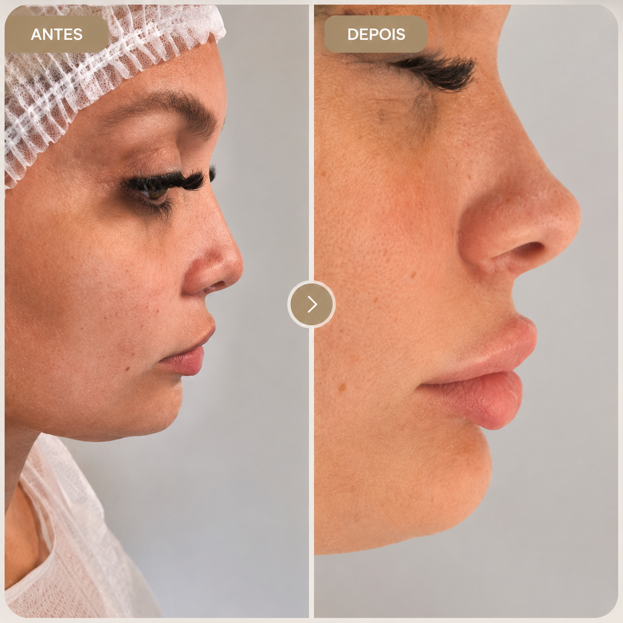 Antes e depois real de perfiloplastia, caso autorizado